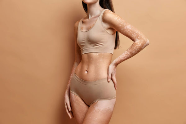 Vitiligo piele