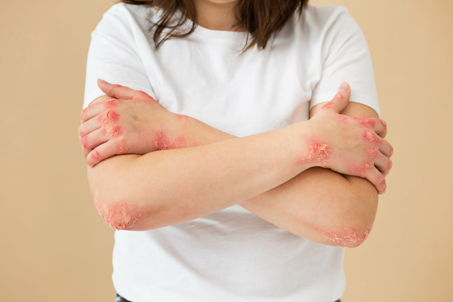 Factori de risc psoriasis Factori de risc psoriasis