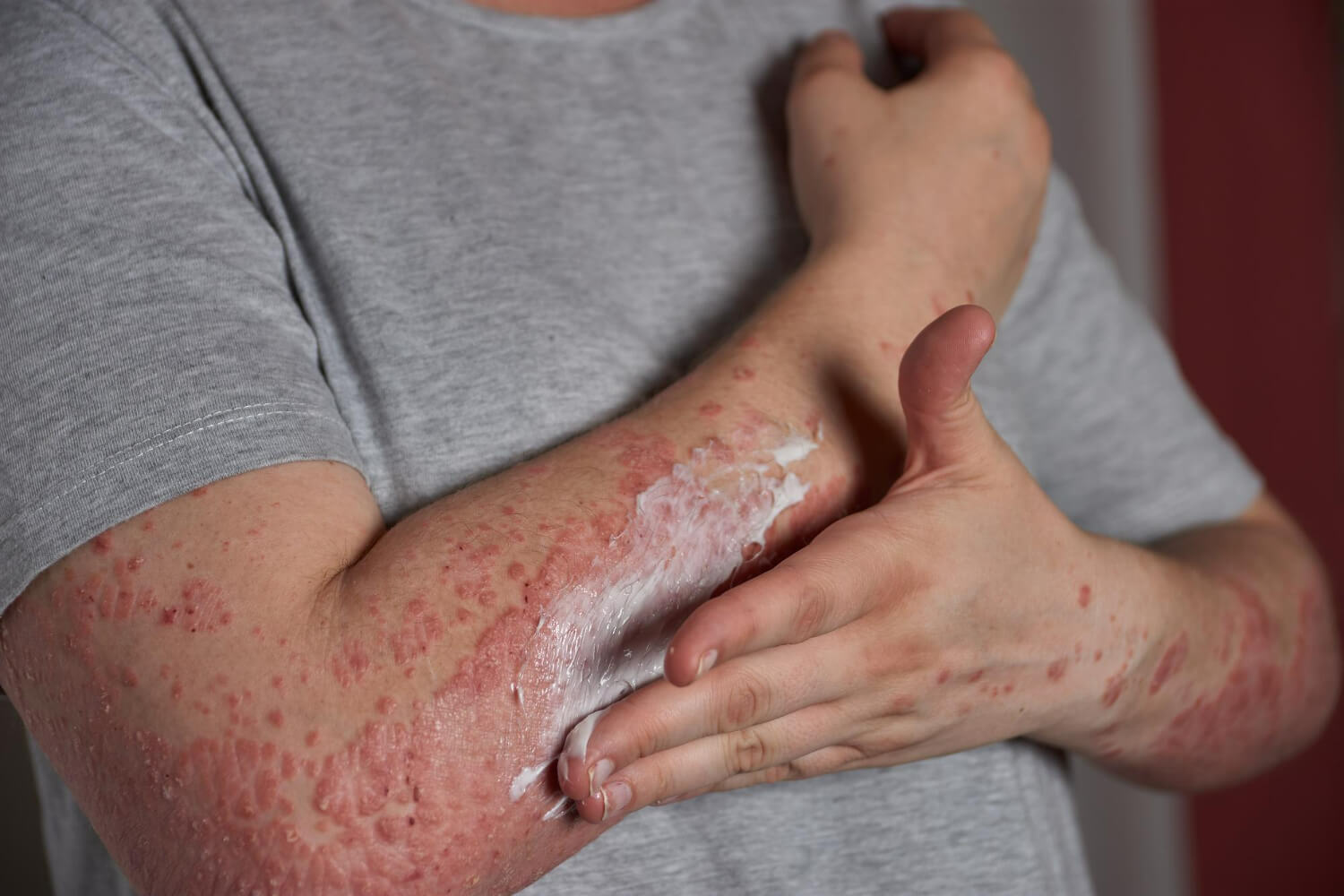 Psoriasis tratament Psoriasis tratament