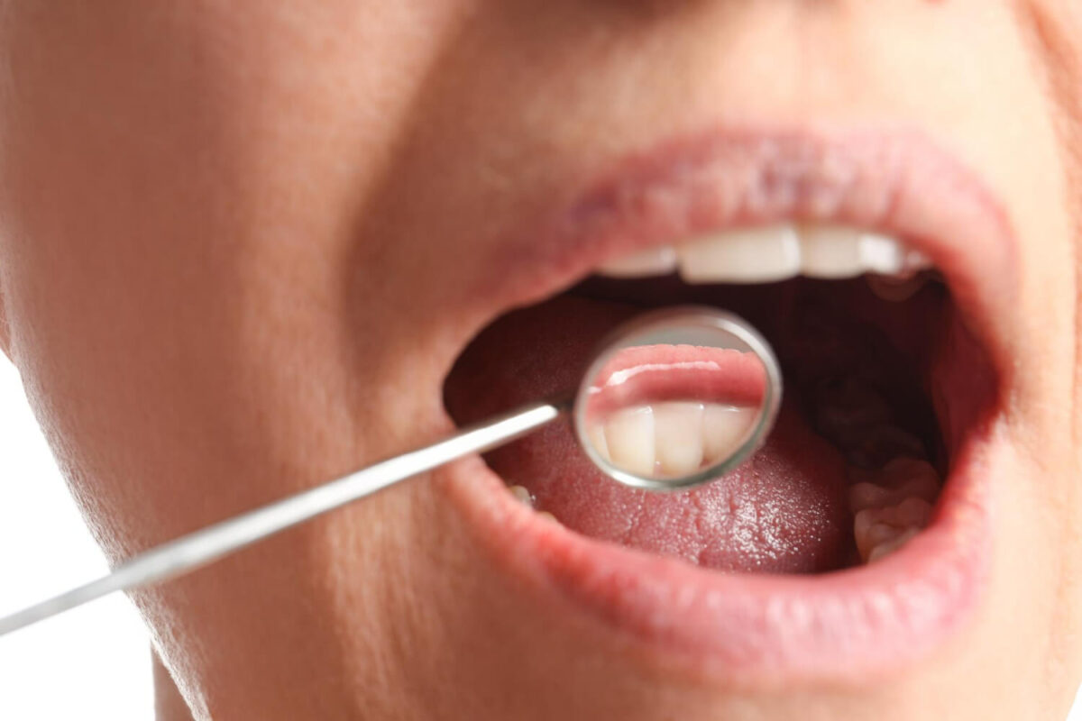 Cancer oral