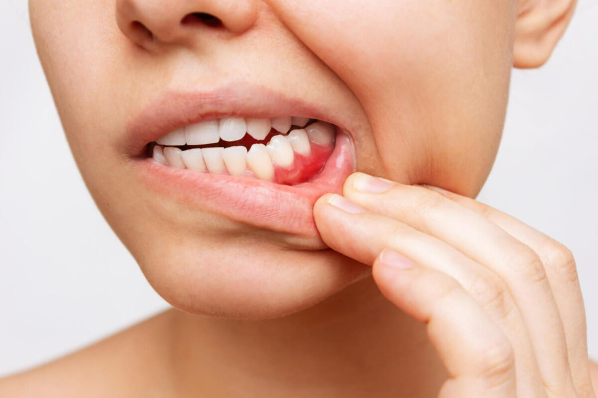 Sangerai gingivale
