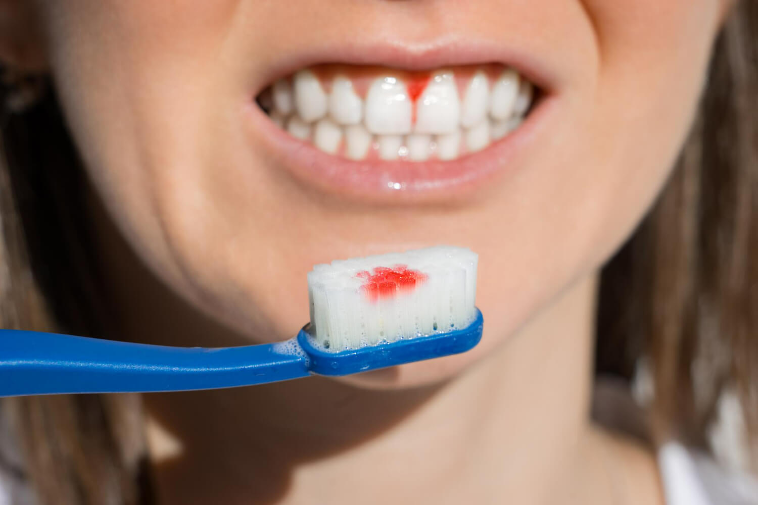Afectiuni dentare care pot cauza sangerare gingivala